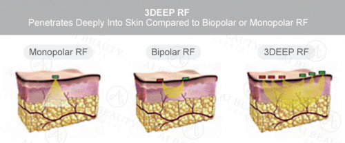 Radiofrequency-3.jpg