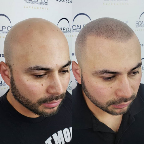 Scalp-Micro-USA.jpg