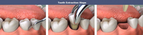 Tooth-Implant-Toronto-ON.jpg