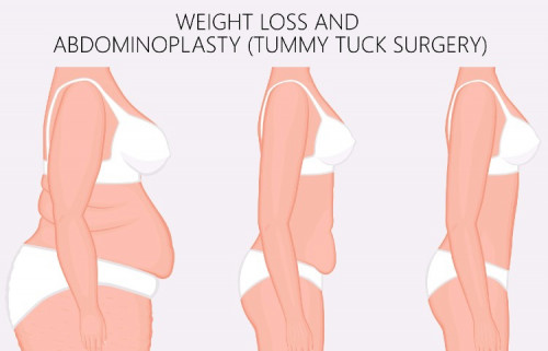 Abdominoplasty-surgery-in-Bangalore---Anew.jpg