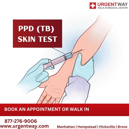 PPD-TB-Skin-Test.jpg